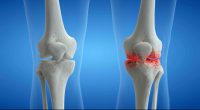 Knee arthritis concept