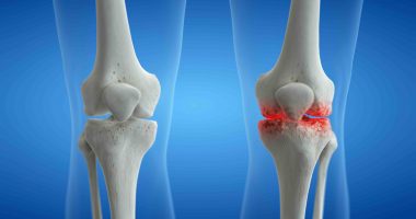 Knee arthritis concept