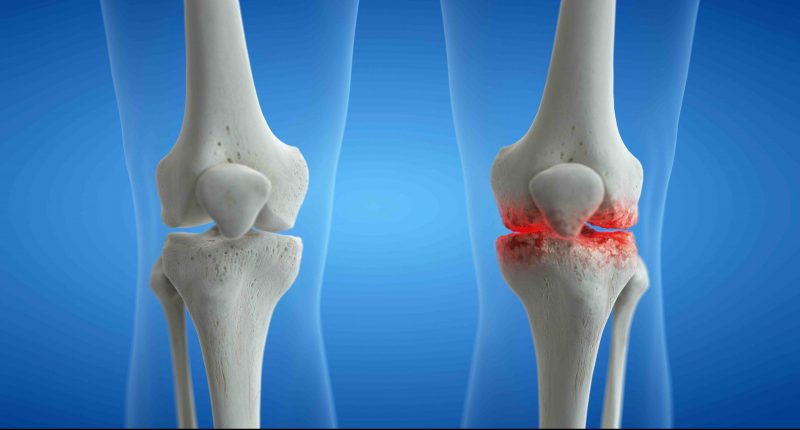 Knee arthritis concept