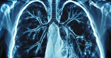 CT scan of lungs