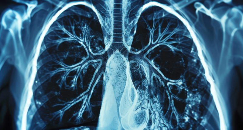 CT scan of lungs